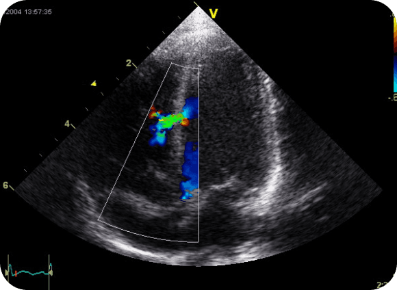 Echocardiogram